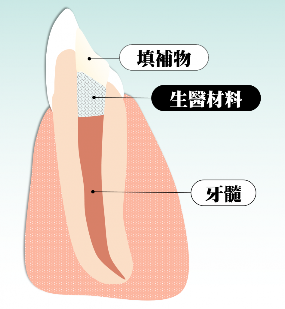 活髓保存術 深度蛀牙的救星 醫師駐站專欄牙齒大小事 竹北品悅牙醫