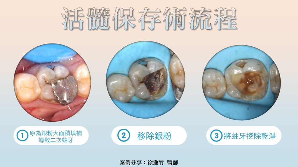 活髓保存術 深度蛀牙的救星 醫師駐站專欄牙齒大小事 竹北品悅牙醫