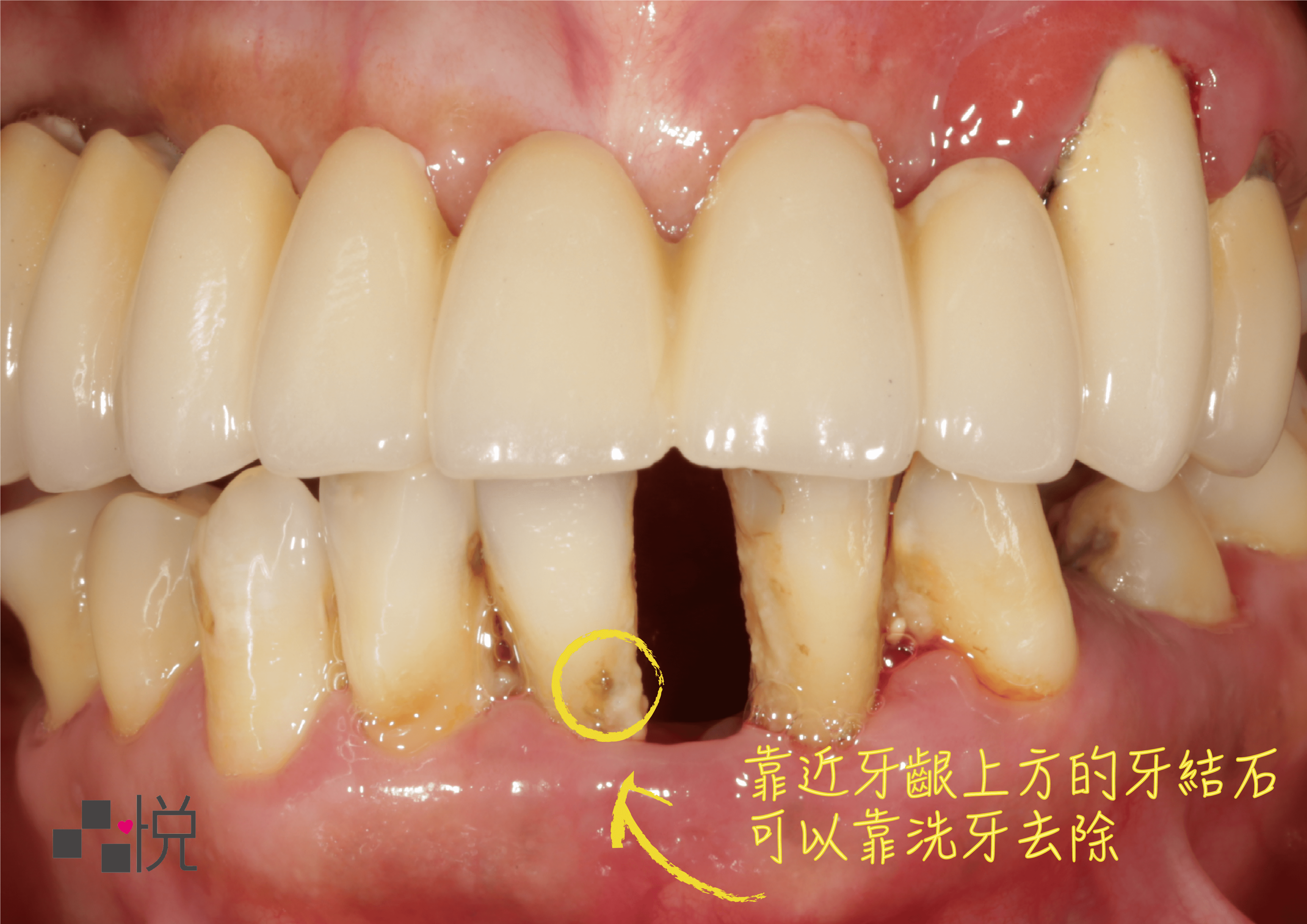 你的牙周病有多嚴重 牙結石深度影響治療方式牙齒大小事 竹北品悅牙醫